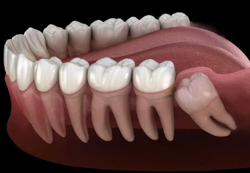 Nằm mơ thấy rụng răng điềm gì