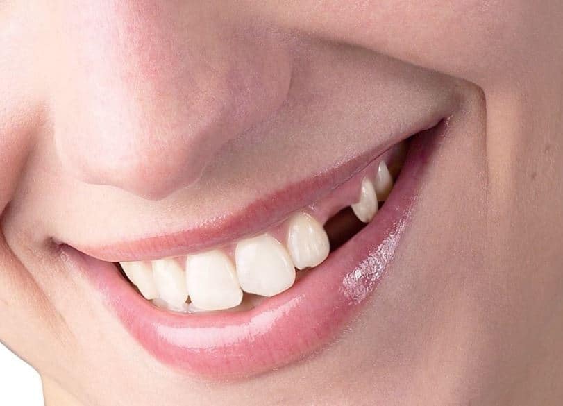 Nằm mơ thấy rụng răng đánh số gì