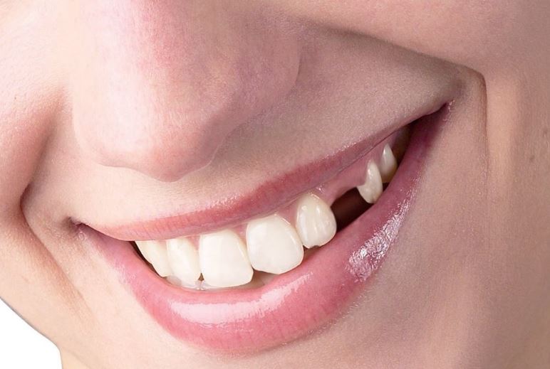 Nằm mơ thấy rụng răng điềm gì